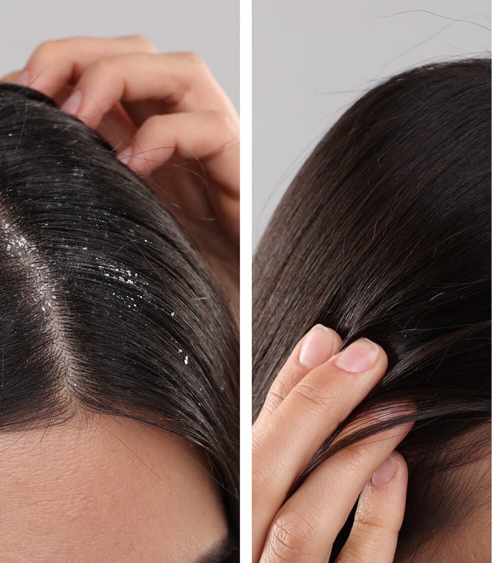 Anti-Dandruff Scalp Peels