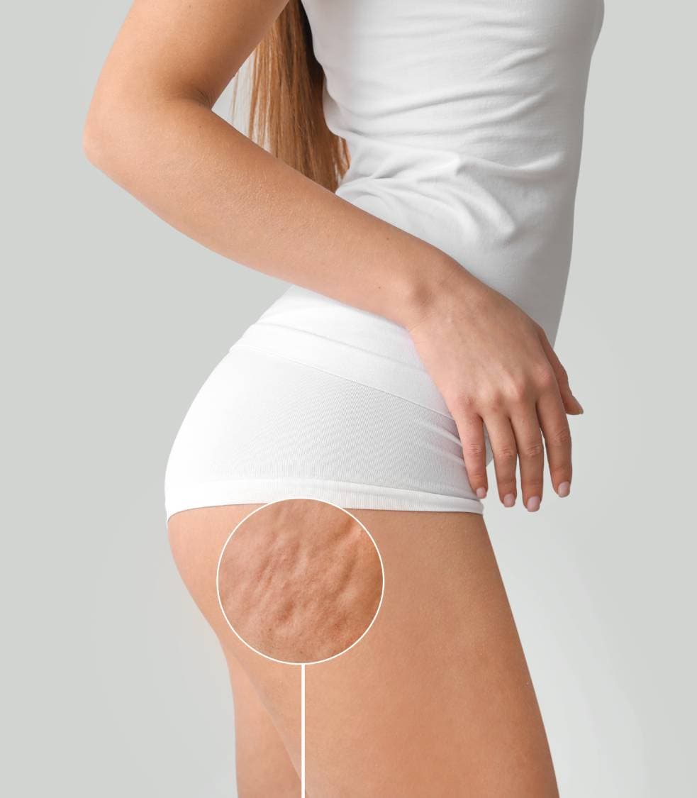 Cellulite Reduction