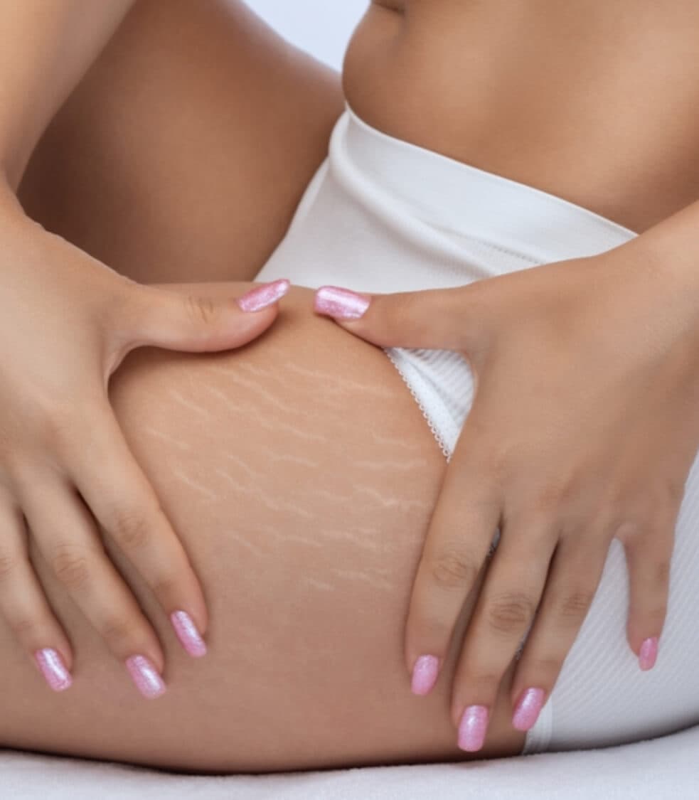 Stretch Mark Camouflage
